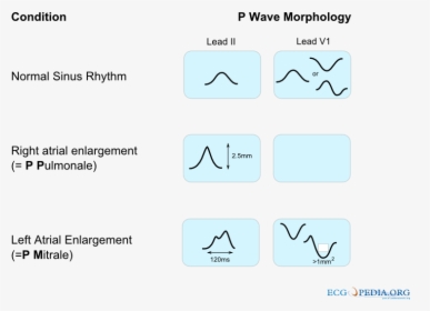 De-p Wave Morphology, HD Png Download, Transparent PNG