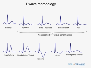 De-t Wave Morphology - T Wave Morphology, HD Png Download, Transparent PNG