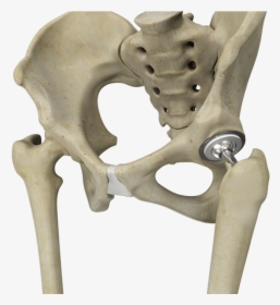 Artificial Hip Joint - Total Hip Replacement Png, Transparent Png, Transparent PNG