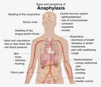 Signs And Symptoms Of Anaphylaxis - Anaphylaxis Symptoms, HD Png Download, Transparent PNG