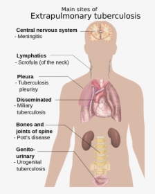 Extrapulmonary Tuberculosis Symptoms - Symptoms Of Tuberculosis, HD Png Download, Transparent PNG