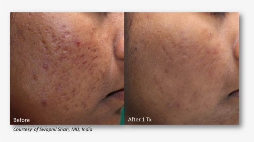 Shah - Lutronic Genius Acne Scarring, HD Png Download, Transparent PNG