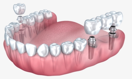 Dental Implant Benefits Summit Nj - Multiple Dental Implants, HD Png Download, Transparent PNG
