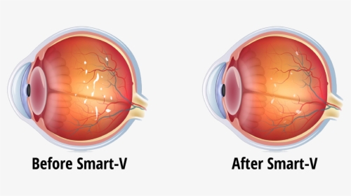 Normal Eye Vs Glaucoma, HD Png Download, Transparent PNG