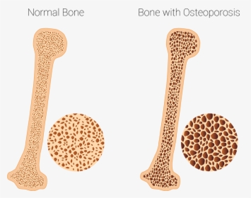 Osteoporosis Clinic - Healthy And Osteoporotic Bone, HD Png Download, Transparent PNG