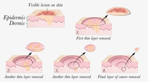 © 2010 Terese Winslow - Skin Cancer Treatment, HD Png Download, Transparent PNG