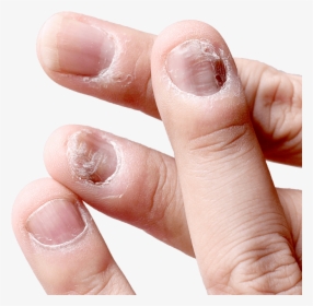 Broken Nails - Loceryl Nail Lacquer 2.5 Ml, HD Png Download, Transparent PNG