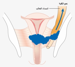 Diagram Showing Stage 3b Cervical Cancer Cruk 226-ar - Cervical Cancer Causing Hydronephrosis, HD Png Download, Transparent PNG