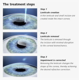 Smile Eye Surgery, HD Png Download, Transparent PNG