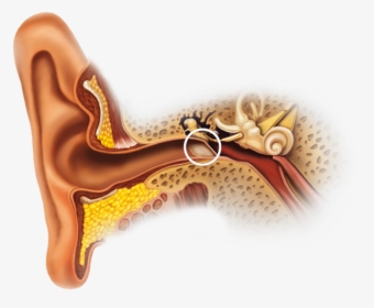Calcification Of Ear Canal, HD Png Download, Transparent PNG