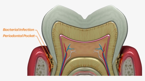 Bacteria Thrive Deep Below The Gum Line In The Periodontal - Tooth, HD Png Download, Transparent PNG