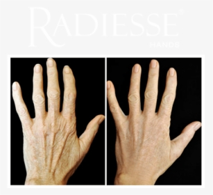 Before And After Treatment With Radiesse® Hands - Ácido Hialurônico Nas Mãos, HD Png Download, Transparent PNG