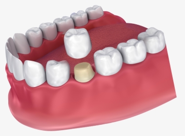 How A Dental Crown Fits - Crown Dental, HD Png Download, Transparent PNG