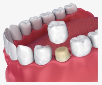 Dental Crown Hovering Over Prepared Tooth - Crown Dental, HD Png Download, Transparent PNG