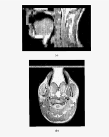 Method Of Terminating The Open Mouth To Contain The - Radiology, HD Png Download, Transparent PNG