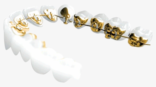 Transparent Gold Teeth Png - Incognito Braces Png, Png Download, Transparent PNG