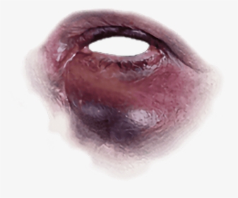Black Eye - Bruise Black Eye Transparent, HD Png Download, Transparent PNG