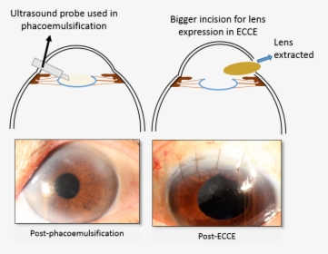 Cataract Surgery - Ecce Cataract Surgery, HD Png Download, Transparent PNG