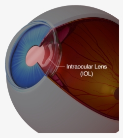A Diagram Of An Eye With An Intraocular Lens - Intraocular Lens, HD Png Download, Transparent PNG