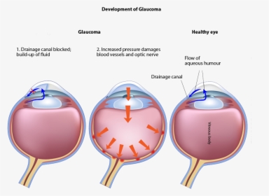 Development Of Glaucoma - Glaucoma Vs Healthy Eye, HD Png Download, Transparent PNG