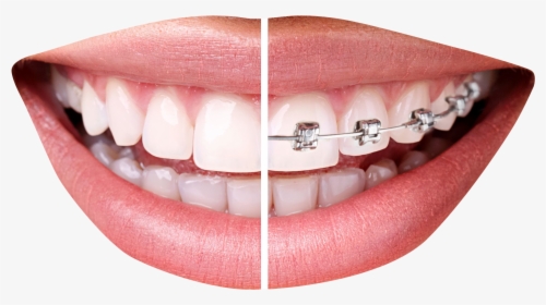 Thumbs Up Png Transparent Image - Teeth Braces Png, Png Download, Transparent PNG