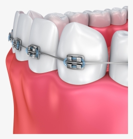 Haltom Orthodontics - Dental Braces, HD Png Download, Transparent PNG