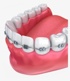Haltom Orthodontics - Tooth Orthodontics Png, Transparent Png, Transparent PNG