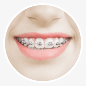 A Woman Smiles Happily With Metal Braces On Her Increasingly - Smiles With Gold Braces, HD Png Download, Transparent PNG