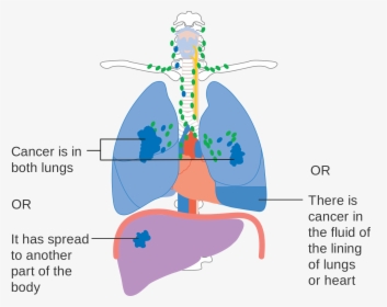 Stage 4 Lung Cancer Diagram, HD Png Download, Transparent PNG