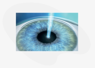 Prk Treatment With Excimer Laser - Bandage Contact Lens After Prk, HD Png Download, Transparent PNG