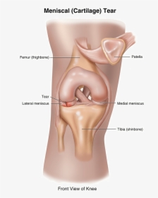 Can A Torn Meniscus Heal Itself - Loose Cartilage In Knee, HD Png Download, Transparent PNG