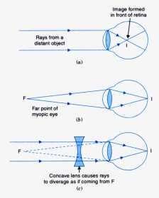 Transparent Human Eyes Png - Correction Of Myopic Eye, Png Download, Transparent PNG