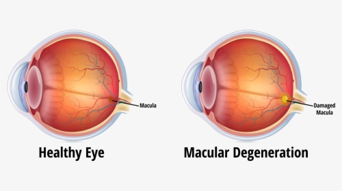 Blindness Caused By Glaucoma, HD Png Download, Transparent PNG