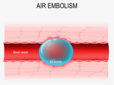 Air Embolism, HD Png Download, Transparent PNG