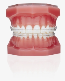 Typodont With Braces, HD Png Download, Transparent PNG