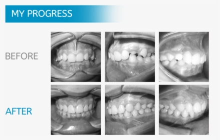 Midwest Orthodontics Chicago - Teeth Xray Before And After Braces, HD Png Download, Transparent PNG