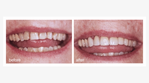 Shot Of Before And After Visiting Abington Smile Gallery - Mouth, HD Png Download, Transparent PNG