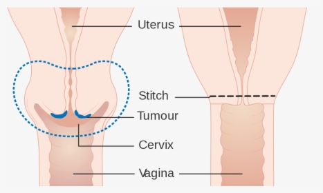 Cervical Amputation - Illustration, HD Png Download, Transparent PNG