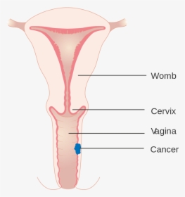 Diagram Showing Stage 1 Vaginal Cancer Cruk - Symmetry, HD Png Download, Transparent PNG