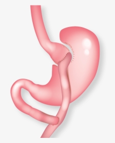 Illustration Of Gastric Bypass - Gastric Bypass Png, Transparent Png, Transparent PNG