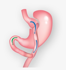 Demonstration Of Gastric Bypass Surgery - Gastric Bypass, HD Png Download, Transparent PNG