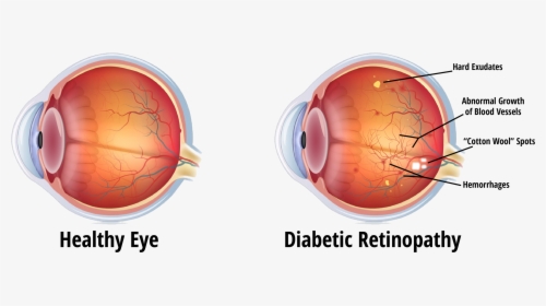 Eye During Diabetic Retinopathy, HD Png Download, Transparent PNG