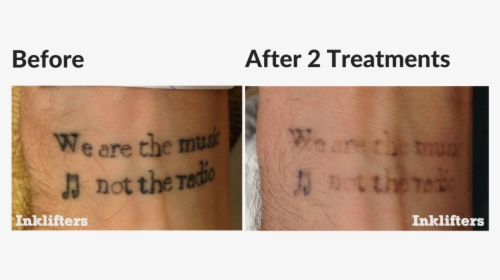 Second Treatment Laser Tattoo Removal, HD Png Download, Transparent PNG