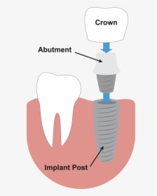 Transparent Tooth Outline Png - Dental Implant Illustration, Png Download, Transparent PNG