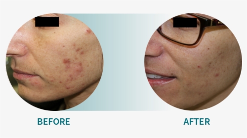Active Acne/acne Scars, HD Png Download, Transparent PNG
