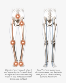 Arch Support Benefits - Orthopedic Bunion Corrector 2.0, HD Png Download, Transparent PNG