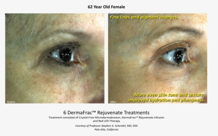 Before & After Dermafrac Skin Rejuvenation Injections - Poster, HD Png Download, Transparent PNG