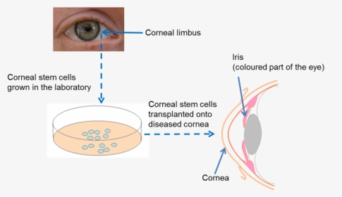 Diagram On Repairing The Cornea - Holoclar Stem Cell, HD Png Download, Transparent PNG
