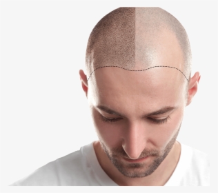 Hair Transplant In Ahmedabad - Transplant Add Fue Hair, HD Png Download, Transparent PNG