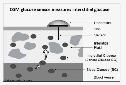 Interstitial Glucose Cgm 4ahs - Continuous Glucose Monitoring Works, HD Png Download, Transparent PNG